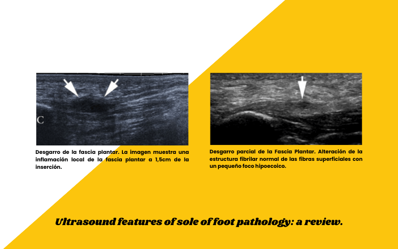 6. Preguntas y respuestas ecografia fascitis plantar delgado plantar osgood schlatter.png